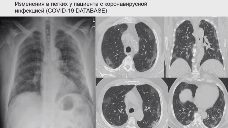 поражение+легких_при_коронавирусе